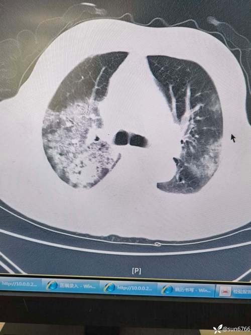 伊犁哈萨克自治州阳性感染者已蔓延23地_伊犁州出现冠状病毒肺炎