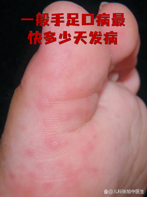 【茂县新增13例无症状感染者及21例无症状,茂县624】